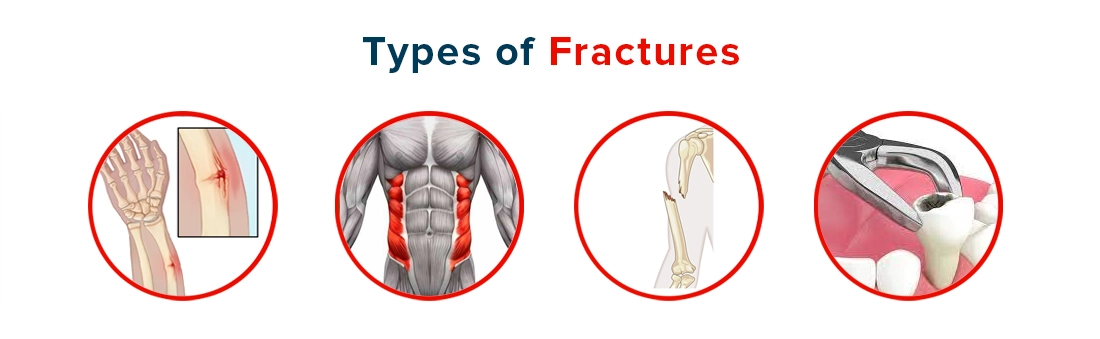 Types of Fractures